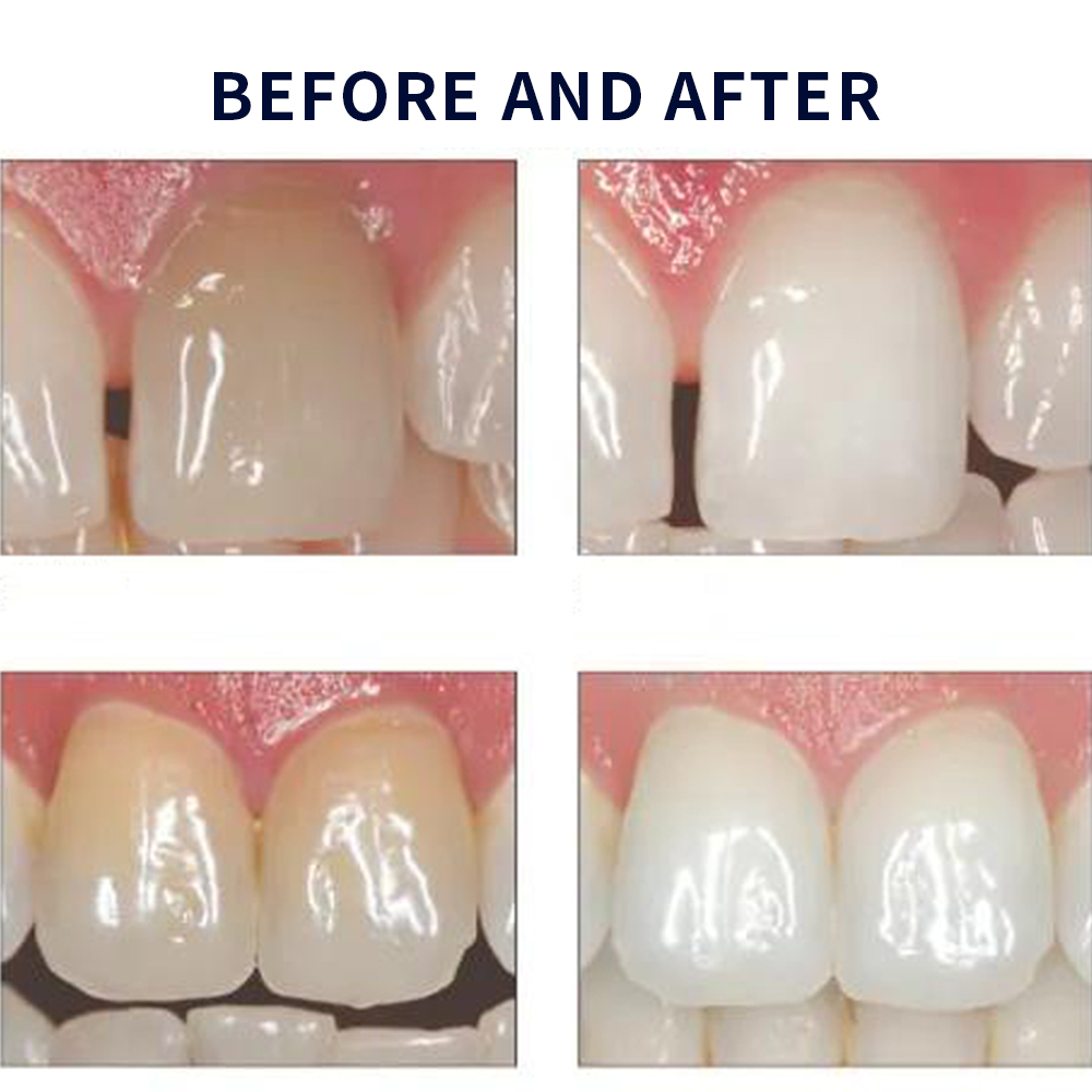 Opalwisdom-Kit de Blanchiment  - Teeth Whitening From Home avis et prix