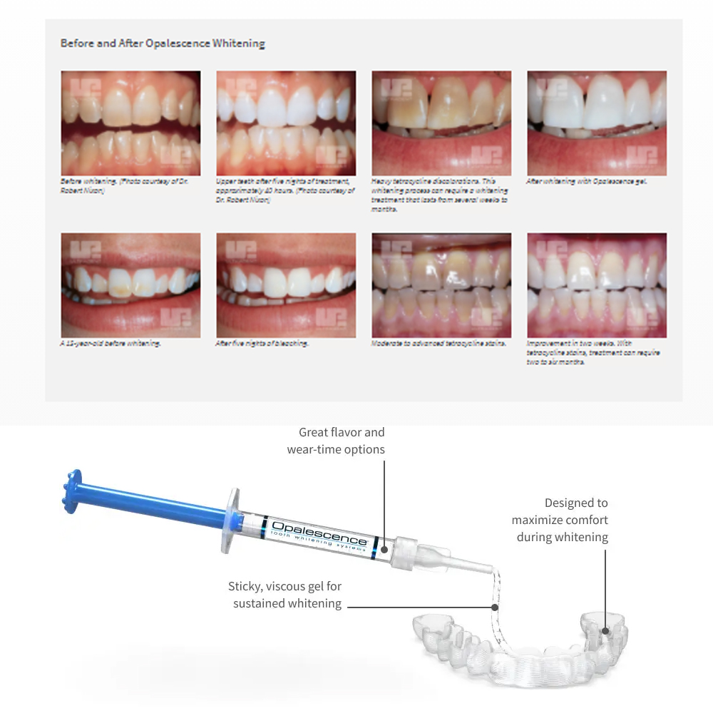 Opalwisdom-Kit de Blanchiment  - Teeth Whitening From Home avis et prix
