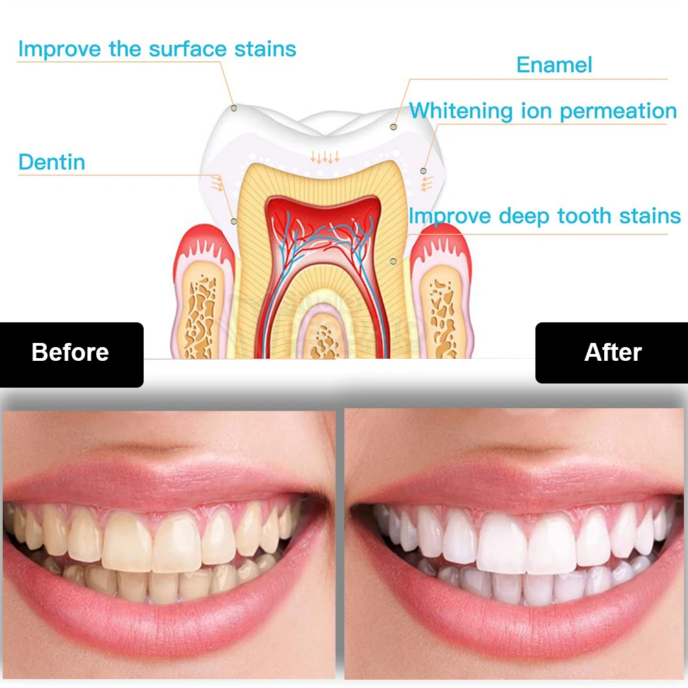 Kit de blanchiment des dents d - Teeth Whitening From Home avis et prix